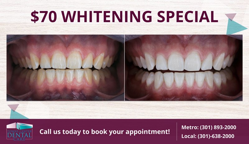 $70 teeth whitening special