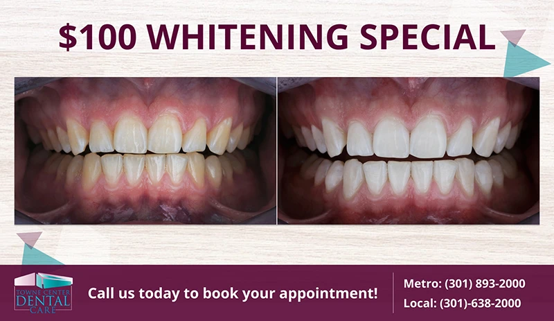 $100 teeth whitening special